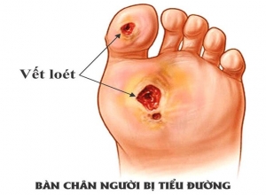 Bệnh tiểu đường và các dấu hiệu cảnh báo ở bàn chân